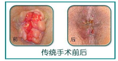 传统手术治疗前后对比