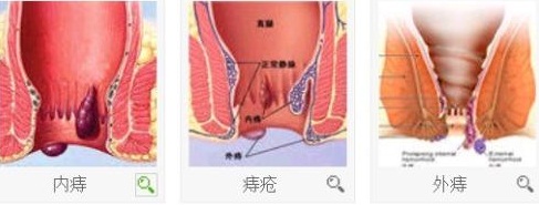 内痔外痔混合痔