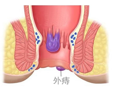 外痔症状