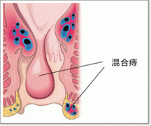 混合痔