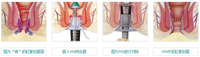 PPH微创术