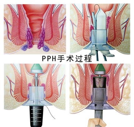 PPH手术过程