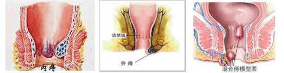 内痔外痔混合痔