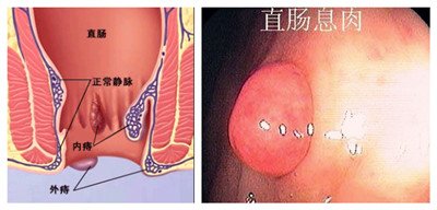 痔疮与息肉区别