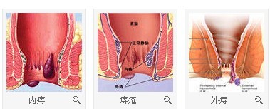 内痔外痔混合痔病理图