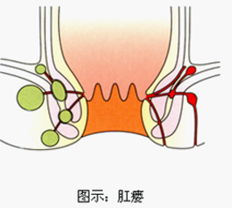 肛瘘病理图