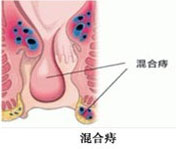 混合痔