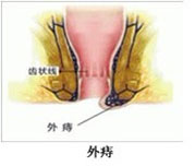 外痔