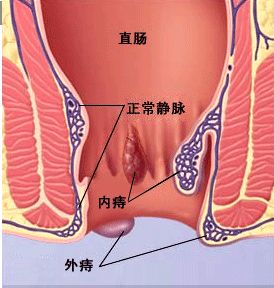 痔疮