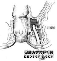 患上肛门疣病严重吗